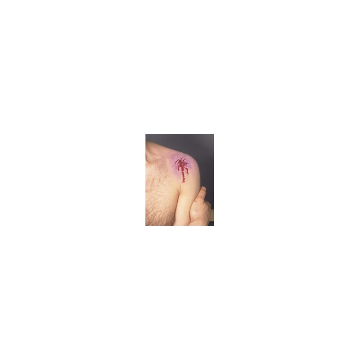 Prothèse blessure éclatée