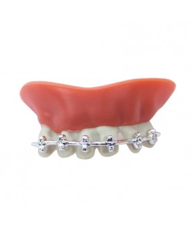 Dentier avec appareil dentaire